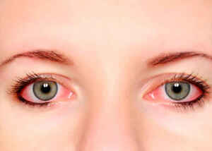 Conjuntivitis Alérgica.
