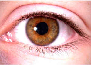 Conjuntivitis